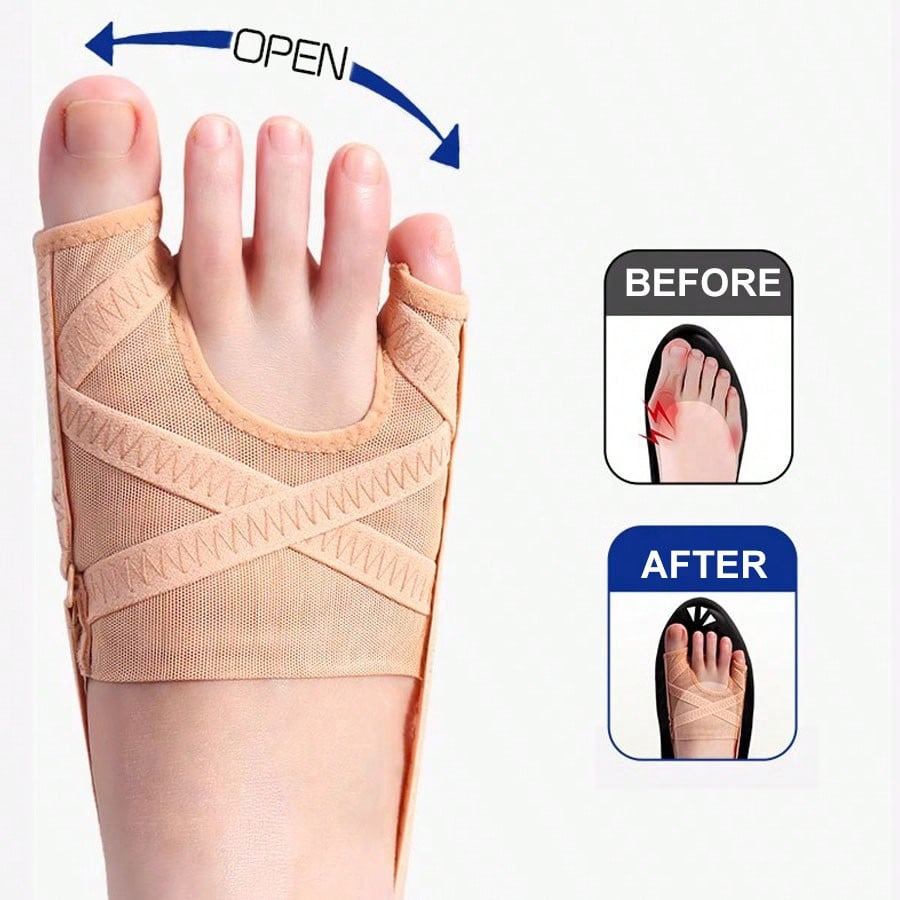 Before and after comparison showing toe alignment improvement using bunion corrector